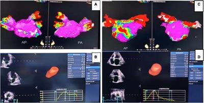 Follow-up study of depressive state on patients with atrial fibrillation 1 year after radio-frequency ablation